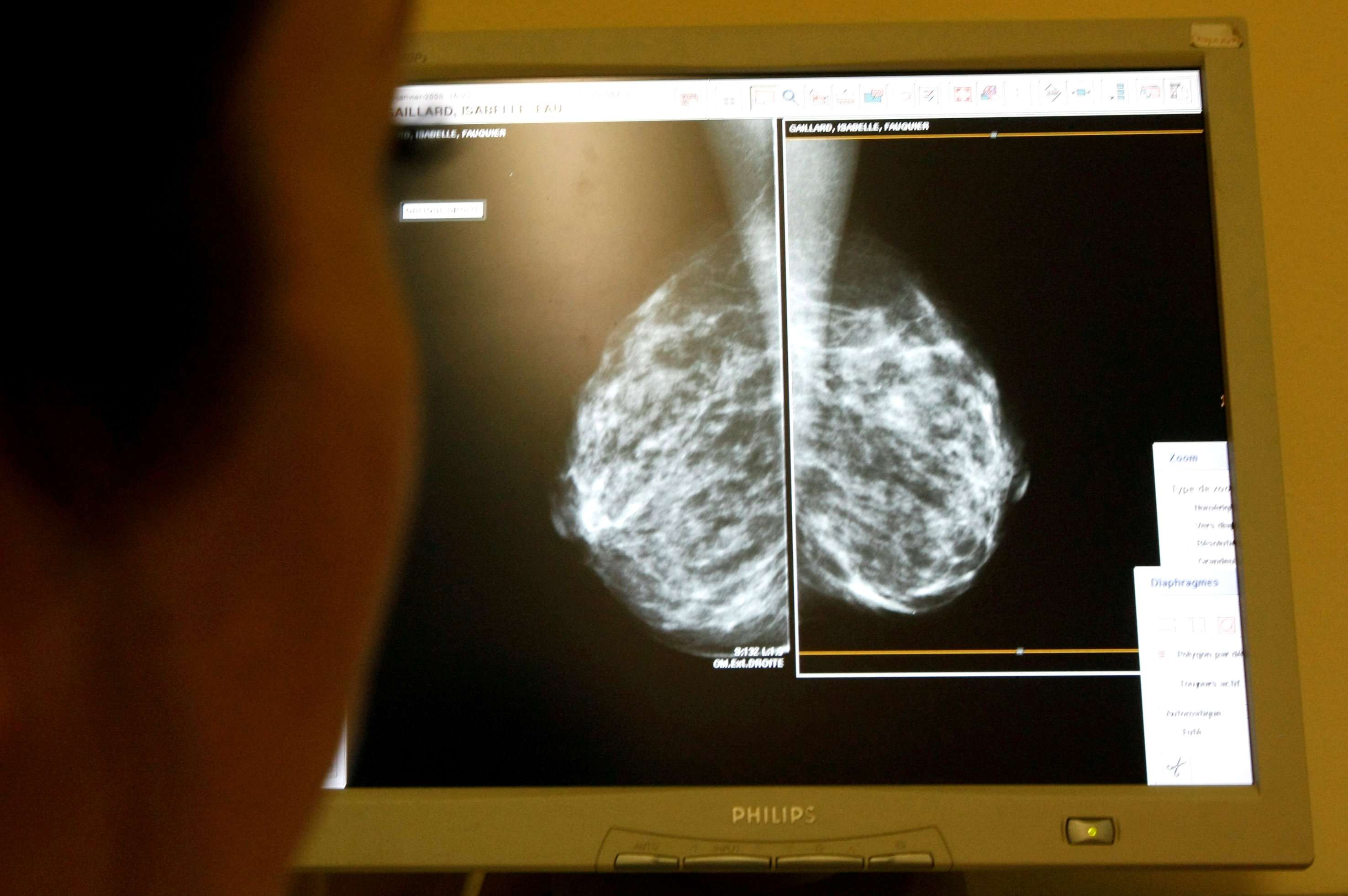 سرطان الثدي 