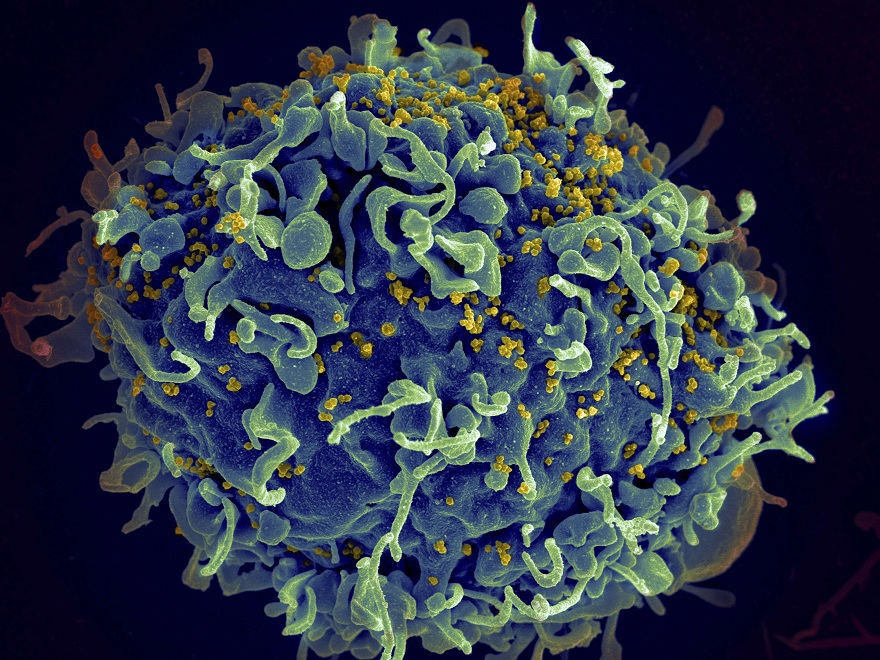 خلية تي بشرية، باللون الأزرق، تتعرض لهجوم من فيروس نقص المناعة البشرية 