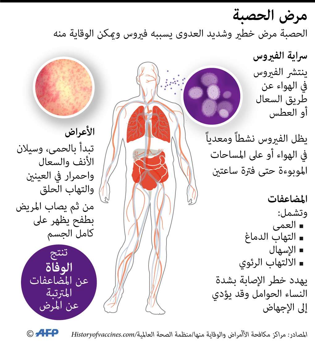 الحصبة