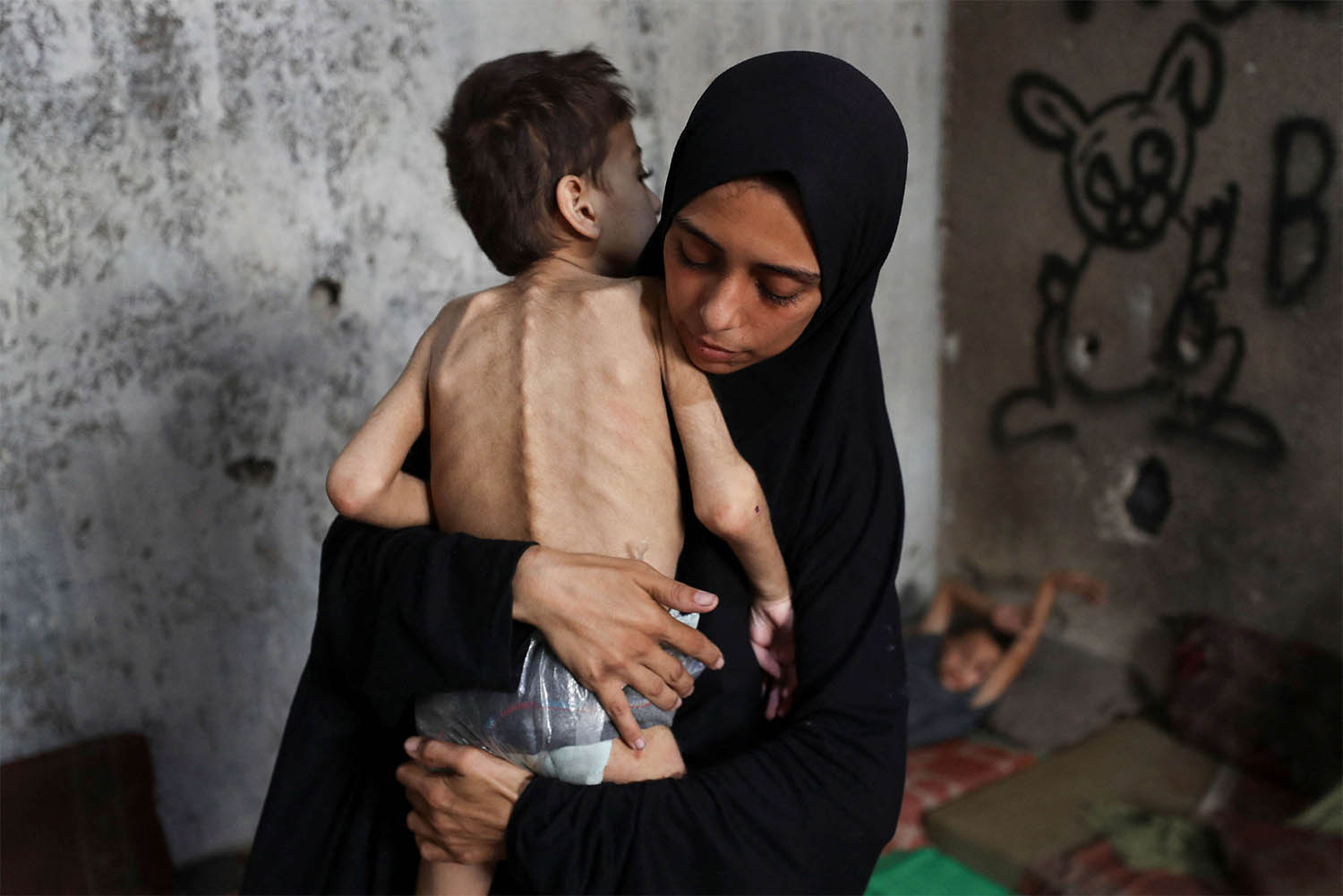 A malnourished child