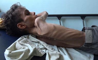 10 year-old Ghazi Saleh lies on a bed at Al-Mudhafar hospital in Taez on November 19, 2018.