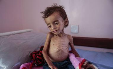 A malnourished boy sits on a hospital bed at the Aslam Health Center, Hajjah, Yemen