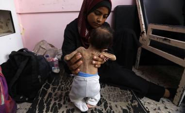 A Palestinian mother holds her malnourished 2-months-old daughter as they await treatment at the Nasser hospital in Khan Yunis
