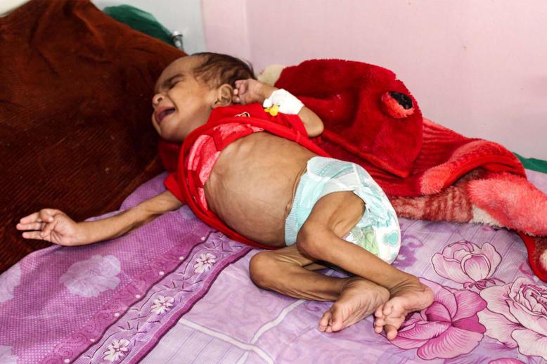 120,000 children are severely malnourished