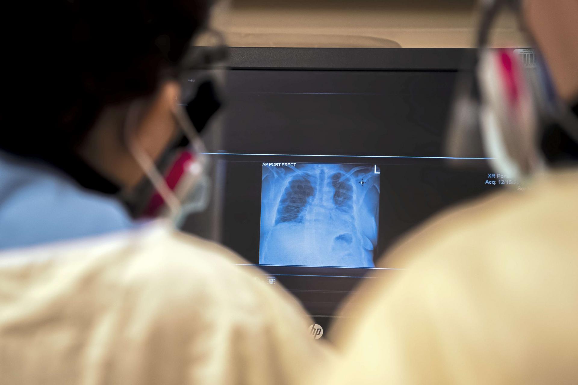 رئة كوفيد