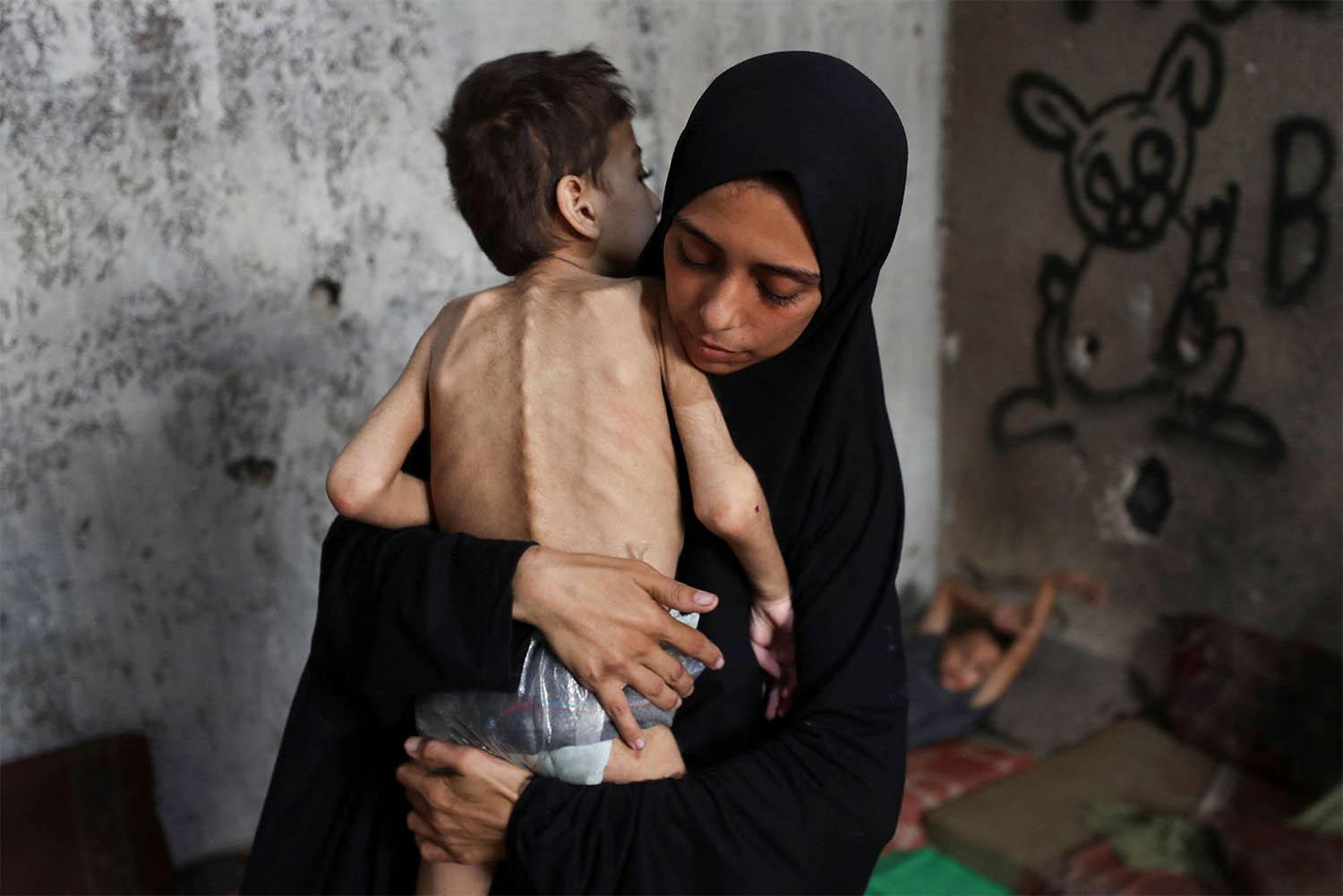 A malnourished child